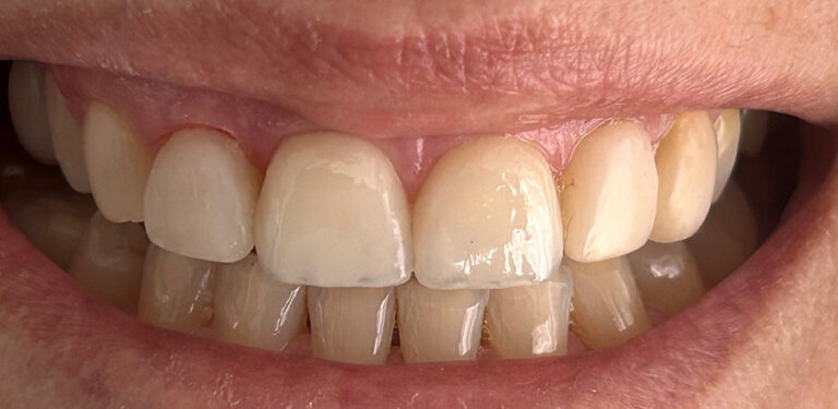 Όψεις πορσελάνης