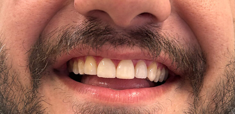 Όψεις ρητίνης